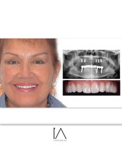All-on-4 Dental Implants - DENTSUADIYE