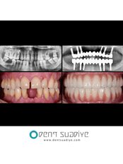 All-on-6 Dental Implants - DENTSUADIYE