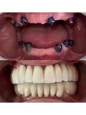 Dental Implants - Dr Hasan Karabeyli