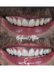 Teeth Whitening - Dr Koralp Güner