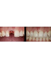 Single Implant - Istanbul Asia Dent
