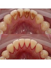 Teeth Cleaning - Istanbul Asia Dent