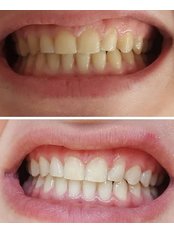 Teeth Whitening - Istanbul Asia Dent
