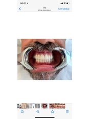 Zirkonkrone - Istanbul Dentestetik