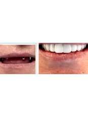 All-on-4 Dental Implants - Klinik+1