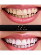 Teeth Whitening - Esthetic Dentistry and Orthodontics treatments Dr.Çınar Gaffari