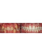 Orthodontics - Esthetic Dentistry and Orthodontics treatments Dr.Çınar Gaffari