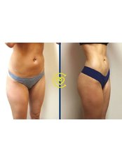 Liposuction - Cayra Clinic