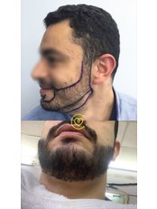 Beard Transplant - Cayra Clinic