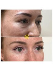 Eyelid Surgery - Cayra Clinic
