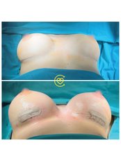 Breast Implants - Cayra Clinic