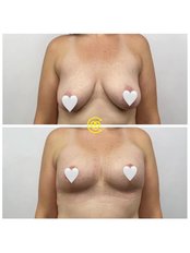 Breast Lift - Cayra Clinic