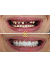 Dental Implants - Cayra Clinic