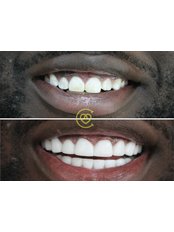Hollywood Smile - Cayra Clinic