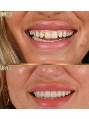 Veneers - Face & Smile Clinic