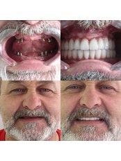 All-on-4 Dental Implants - Cerrahi Group Dental Clinic