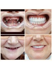 All-on-4 Dental Implants - Cerrahi Group Dental Clinic
