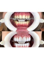Dental Crowns - Cerrahi Group Dental Clinic