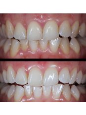 Teeth Whitening - Dentofis