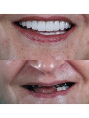 Dental Implants - Natural Clinic Dental