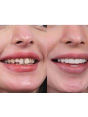 Hollywood Smile - Natural Clinic Dental