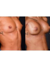 Breast Implants - Natural Clinic