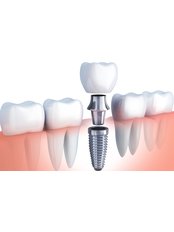 Dental Implants - Mevsim Dental Clinic