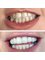 Dr. Yesim Makzume  Aesthetic Dentistry Oral İmplantology Specialist - Bleaching 
