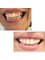 Dr. Yesim Makzume  Aesthetic Dentistry Oral İmplantology Specialist - Smile Transformation with implants and veneers 