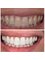 Dr. Yesim Makzume  Aesthetic Dentistry Oral İmplantology Specialist - composite layering smile transformation 