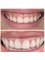 Dr. Yesim Makzume  Aesthetic Dentistry Oral İmplantology Specialist - Gum levelling and composite layering smile transformation 