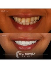 Dental Crowns - Health Point Clinic