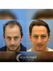 DHI - Direct Hair Implantation - Health Point Clinic
