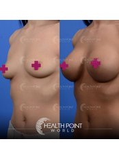 Breast Lift - Health Point Clinic
