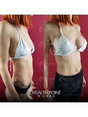 Breast Implants - Health Point Clinic