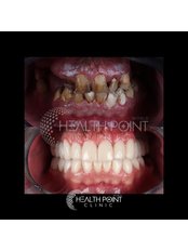 Dental Implants - Health Point Clinic