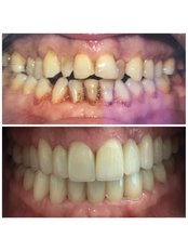 Porcelain Veneers - OkutanDis Halkali Dental Clinic