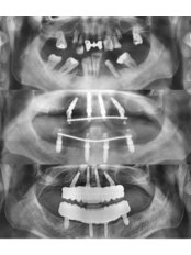 All-on-4 Dental Implants (Nobel Biocare) (per jaw) - OkutanDis Halkali Dental Clinic