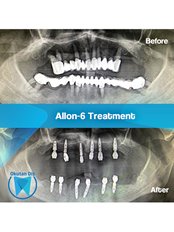 All-on-6 Dental Implants (Zinedent/Straumann Group) (per jaw) - OkutanDis Halkali Dental Clinic