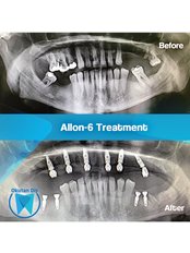 All-on-6 Dental Implants (Zinedent/Straumann Group) (per jaw) - OkutanDis Halkali Dental Clinic