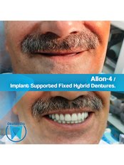 All-on-4 Dental Implants (Zinedent/Straumann Group) (per jaw) - OkutanDis Halkali Dental Clinic