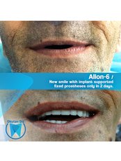 All-on-6 Dental Implants (Nobel Biocare) (per jaw) - OkutanDis Halkali Dental Clinic