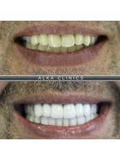 Hollywood Smile - Alka Dental