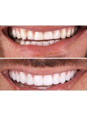 Zirconia Crown - Alka Dental