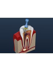 Root Canal Treatment - Koray Dental Clinic