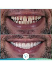 Hollywood Smile - Koray Dental Clinic