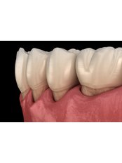 Periodontitis Treatment - Koray Dental Clinic