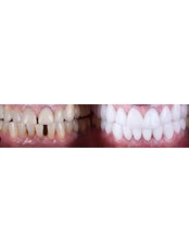 Zirconia Crown - Oval Dental Clinic