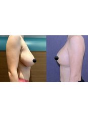 Breast Reduction - TWT Health