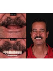 Hollywood Smile with Zirconium Crowns - TWT Health